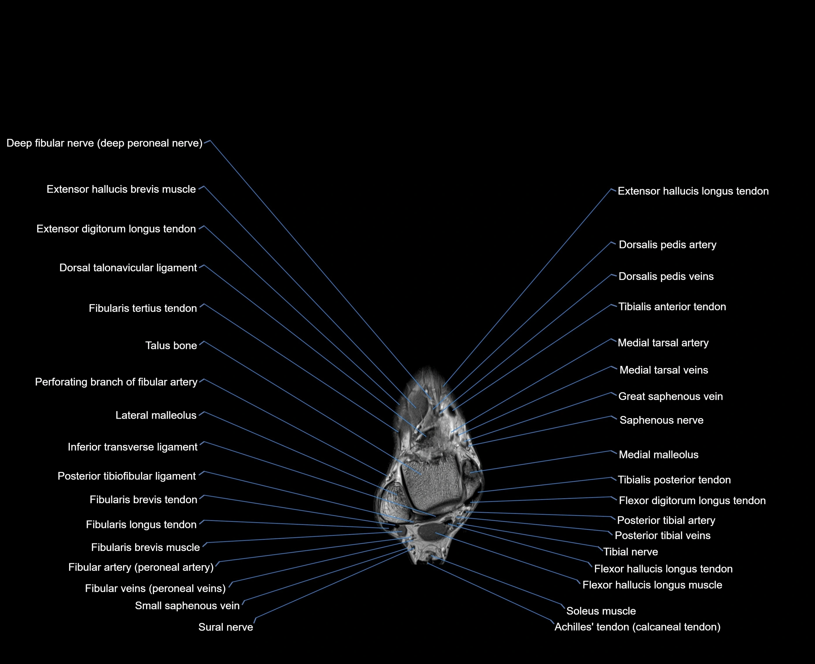 MRI foot coronal cross sectional anatomy 3T  radiology  image-img-00001-00008.webp